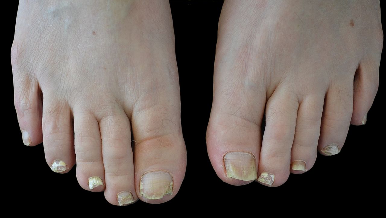 Fingernail Fungus From Acrylic Nails - Prevention, Treatment, Pics & More
