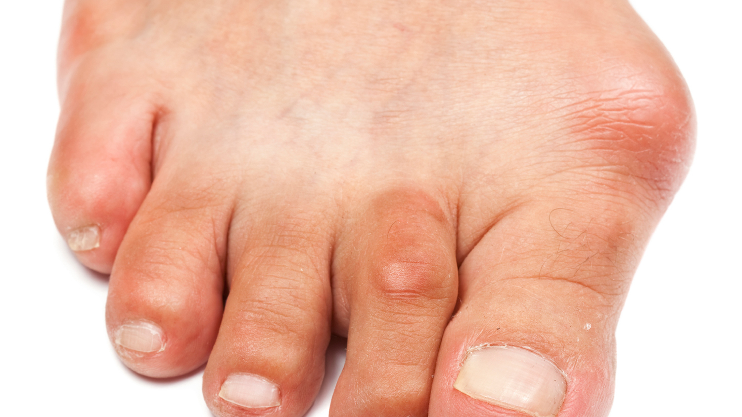 facts-about-bunions-you-should-know-dr-sami-podiatrist-dubaidr-sami